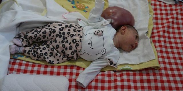 Doktorların "Ölür" dedikleri 2 kafalı doğan bebekleri için çare arıyorlar